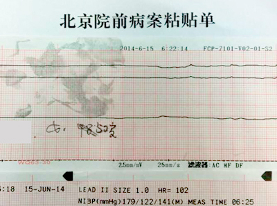 MCC心肺复苏机成功抢救心脏骤停病人一例